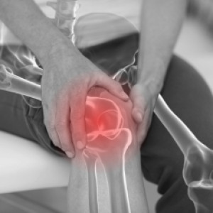 Пациентка с диагнозом деформирующий остеоартроз коленных суставов 2 степени