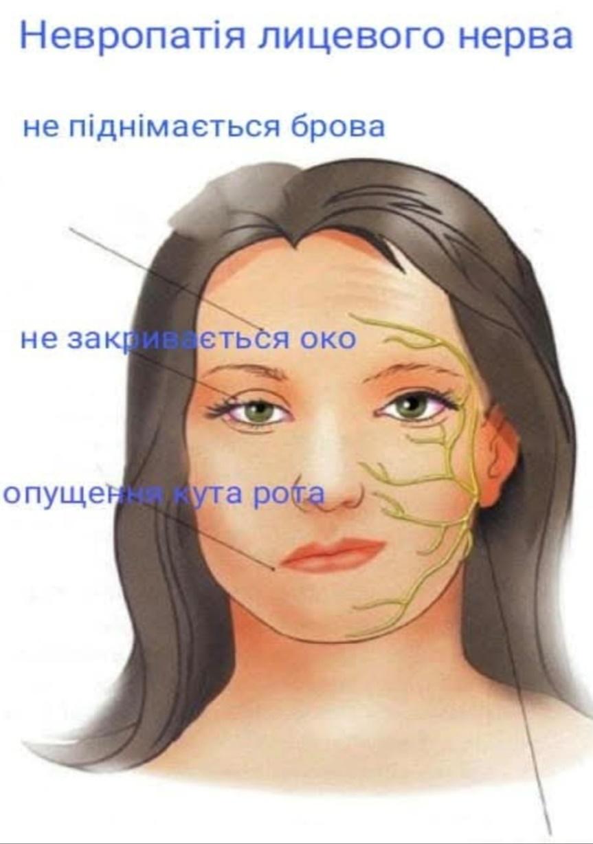 Симптоми невропатії